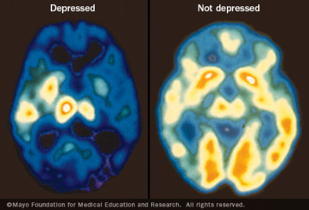 Ruhsal bozukluk nedir - depresyon beyni